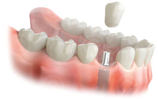 Teeth Implant