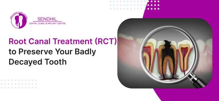 Root Canal Treatment (RCT)