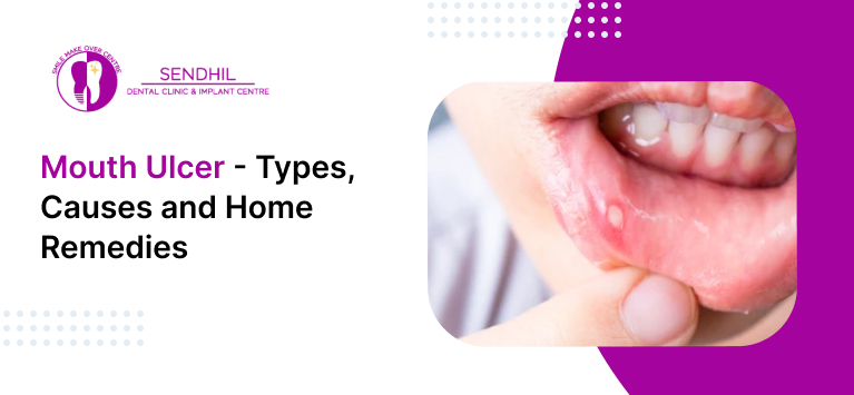 Mouth ulcer- Types, Causes and Home Remedies
