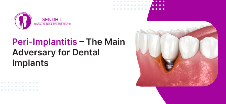 Peri-Implantitis – The main adversary for dental implants
