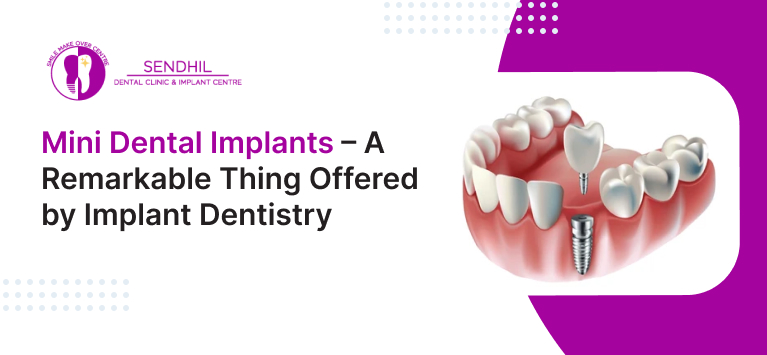 Mini dental implants – A remarkable thing offered by Implant Dentistry