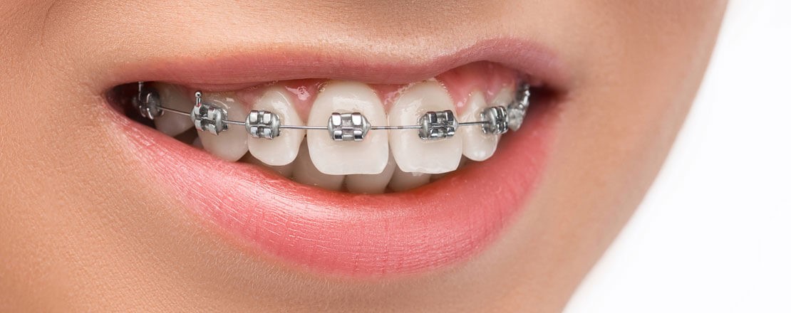 Types of Braces for Teeth