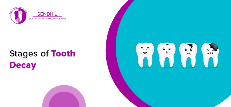 Stages of tooth decay