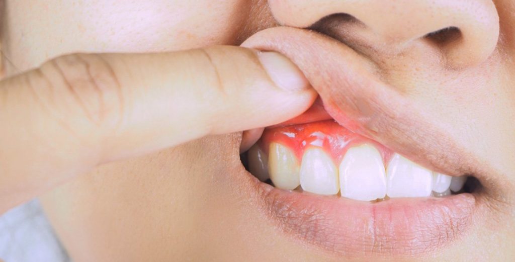 gum-swelling-remedies