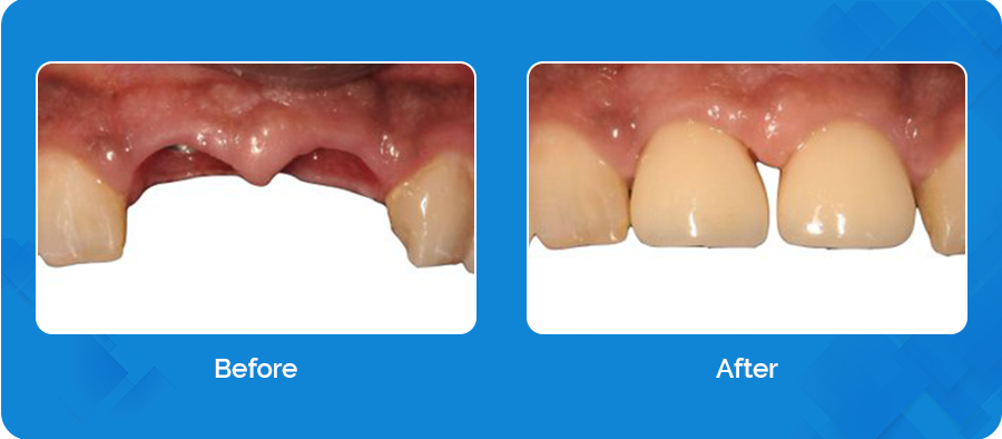 Before-After