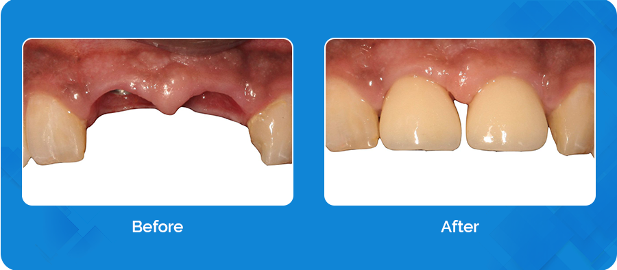 Before-After