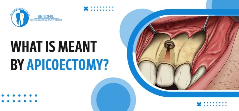 apicoectomy-reverse-root-canal-root-end-surgery