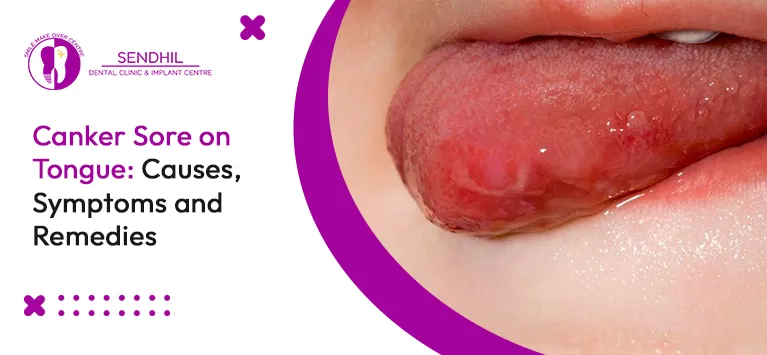 ﻿Canker Sore on Tongue