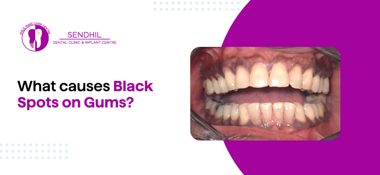 black spots on gums