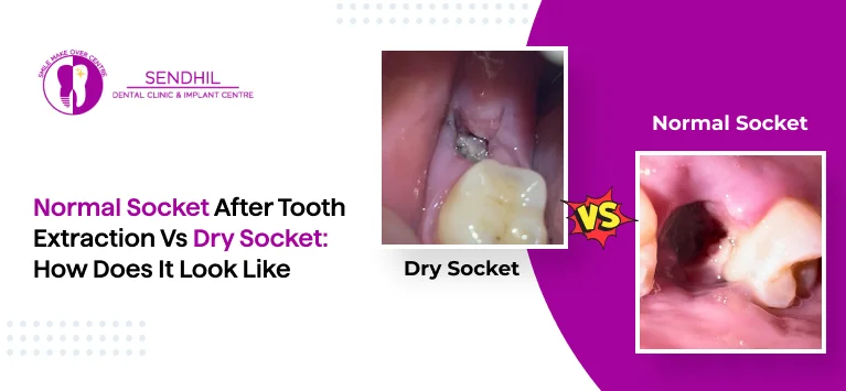 Normal Socket After Tooth Extraction Vs Dry Socket: How Does It Look Like