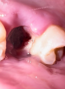 Normal socket After tooth extraction