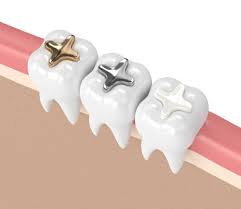 types of cavity fillings