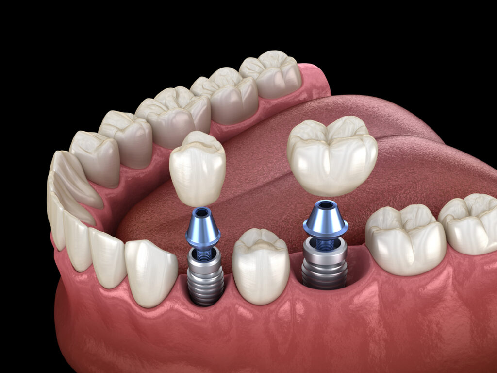 dental implant images