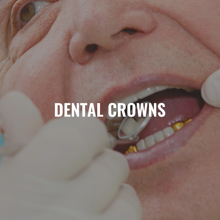 Dental Crowns in Chennai