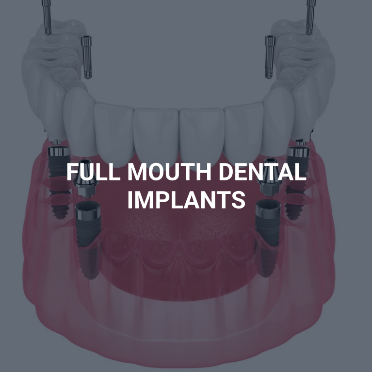 Full Mouth Dental Implants in Chennai