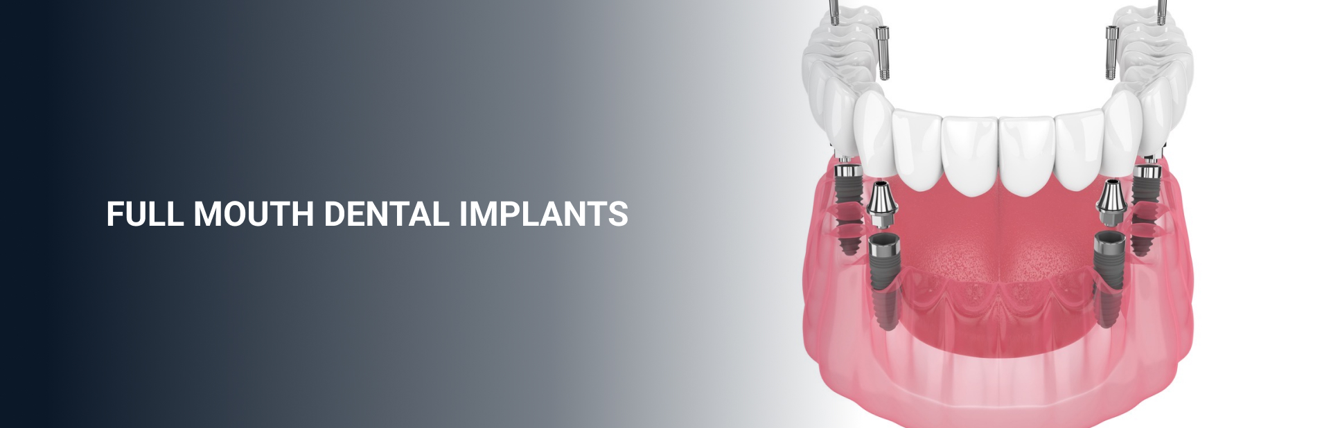 Full Mouth Dental Implants in Chennai