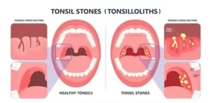 How to Remove Tonsil Stones at Home?