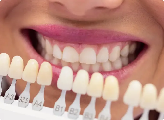 Best Dental Veneers in Chennai