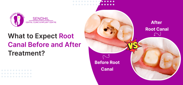 root canal before and after pictures