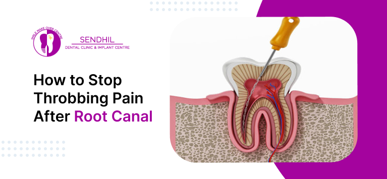 How to Stop Throbbing Pain After Root Canal