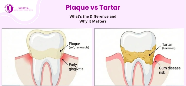 Plaque vs Tartar