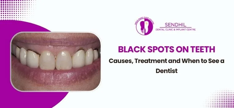 Black-Spots-on-Teeth