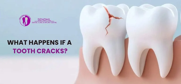 What-Happens-If-a-Tooth-Cracks.